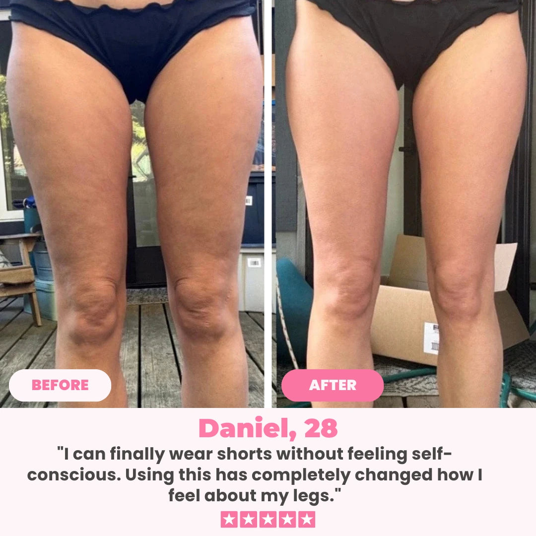 Cellulift Pro™ Cellulite Cupping Massager
