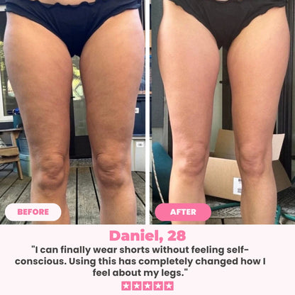Cellulift Pro™  Cellulite Cupping Massager